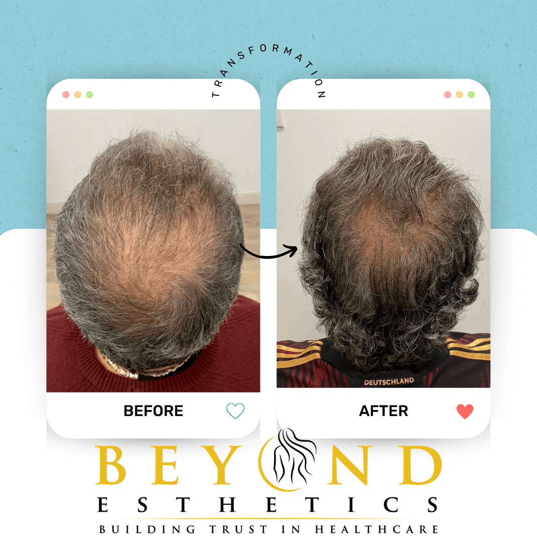 TED Hair Restoration
